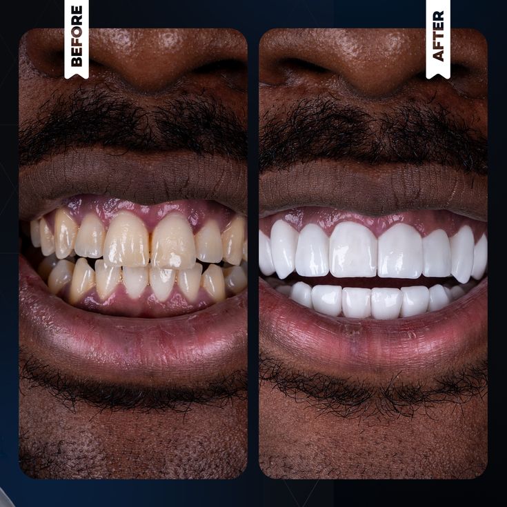 🦷 RETROUVE UN SOURIRE BLANC ET FRAIS… SANS EFFORT, DÈS AUJOURD’HUI